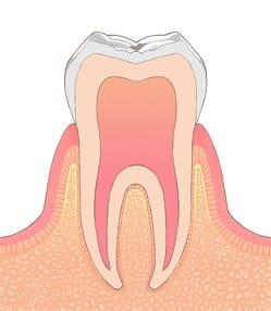 むし歯の進行段階C-0