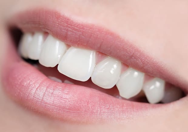 矢向ホワイト歯科のダイレクトボンディング