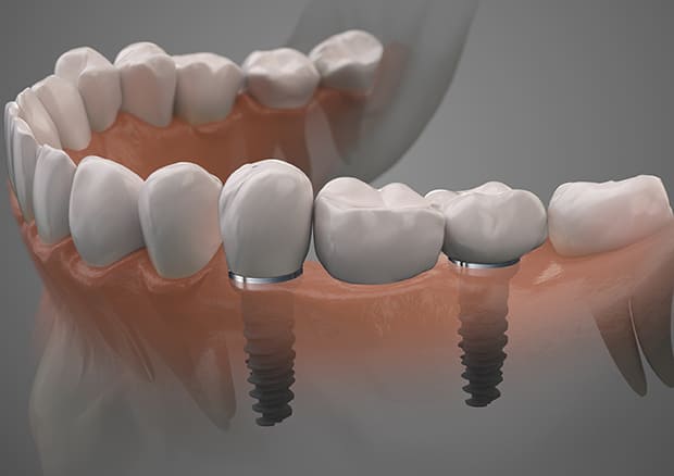 インプラント複数本欠損のケース