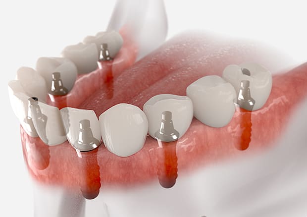 インプラントブリッジ