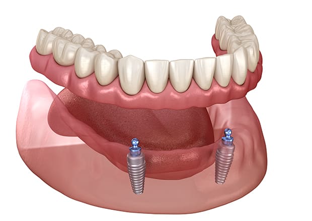 オーバーデンチャー