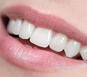 ダイレクトボンディング