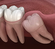 口腔外科/親知らず抜歯