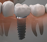 当院のインプラント治療