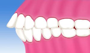 出っ歯、上顎前突