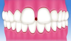 すきっ歯（空隙歯列弓）