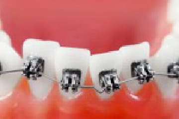 歯並びが気になる