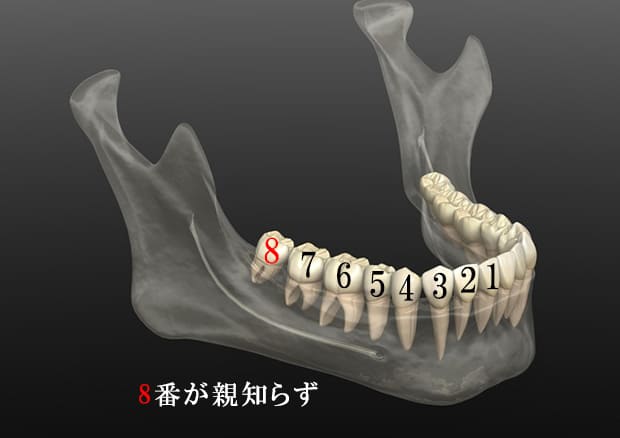 痛みの少ない親知らずの抜歯