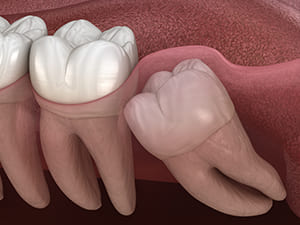 斜めに生えている親知らず